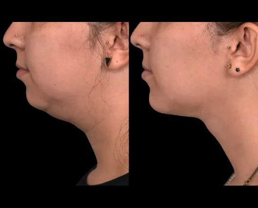 Double chin removal in Dubai