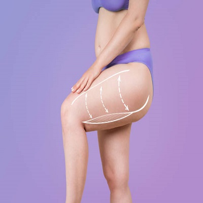 Liposuction in Riyadh 1