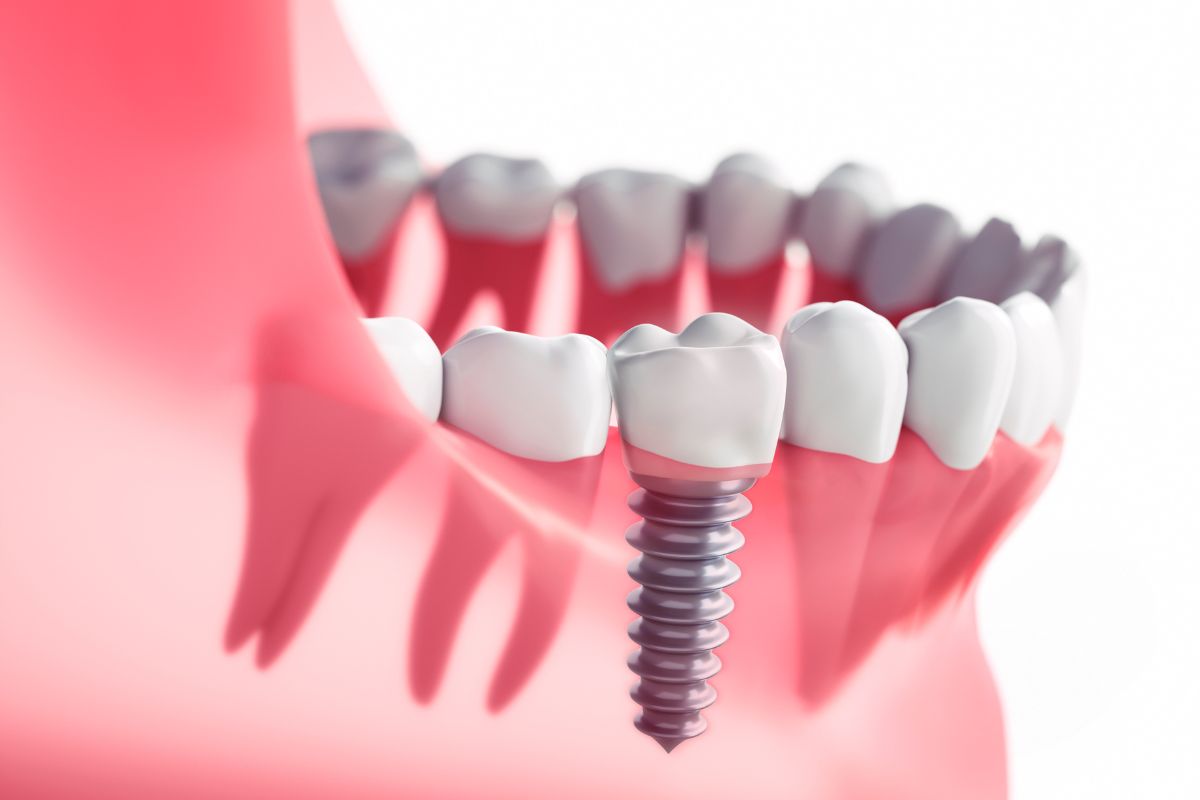 Best dental Implant Aberdeen